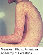 Measles Outbreak Hits Texas Megachurch