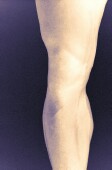 Weight-Loss Surgery Might Help Mild Knee Pain