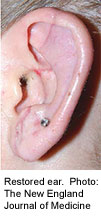Leeches Help Save Woman's Ear After Pit Bull Mauling