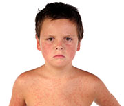 U.S. Measles Cases at 20-Year High