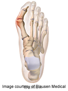 Take Steps to Control Bunions