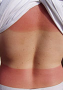 Fewer U.S. Teens Using Sunscreen, Study Finds