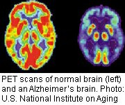 Scientists Inch Closer to Alzheimer's Origins
