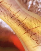 Treating Irregular Heartbeat With Digoxin May Come With Risks