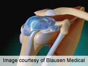 Prompt Treatment of Shoulder Dislocation May Prevent Future Problems