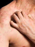 Eczema Linked to Other Health Problems