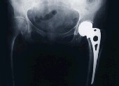 Number of Hip Replacements Has Skyrocketed, U.S. Report Shows