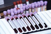 Do Heart Surgery Patients Get Too Many Blood Tests?