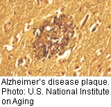 Mouse Study Suggests Immune Disorder May Play Role in Alzheimer's