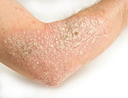 Injuries Up Risk of Psoriatic Arthritis for People With Psoriasis