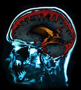 Brain May Recover From Concussion by Compensating