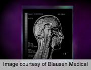 MRI Might Allow Earlier Diagnosis of Dyslexia: Study