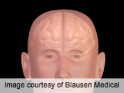 Brain Lesions More Common in High-Altitude Pilots, Study Finds