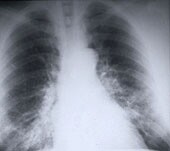 Discovery May Help Pinpoint Risk of Lung Cancer Returning After Surgery