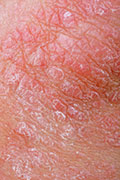 Skin Care Tips for Psoriasis Patients
