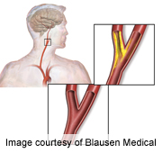 Stenting of Neck Arteries  Tied to Higher Stroke Risk in Seniors