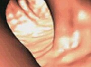 Current Colon Cancer Screening Guidelines Might Miss Some Patients