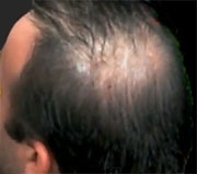 Baldness Cure May Have Inched a Bit Closer