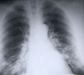 COPD Patients Face Greater Risk of Heart Failure, Study Says