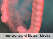 Half a Million Cancers Prevented by Colon Screenings: Study