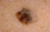 Melanoma Drug Trials Show Significant Promise