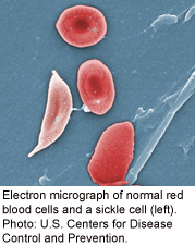 New Guidelines for Sickle Cell Disease