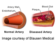 Early Heart Disease May Lead to Impotence, Study Says