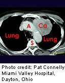 Medicare to Cover Lung Cancer Screening for Long-Time Smokers