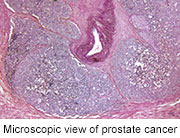 Radiation Plus Hormone Therapy May Help Some Prostate Cancer Patients