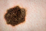 Could a Laser Skin Test Someday Replace Biopsy to Spot Melanoma?