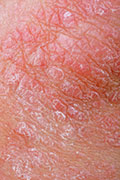 Psoriasis, Depression Often Go Hand in Hand: Study