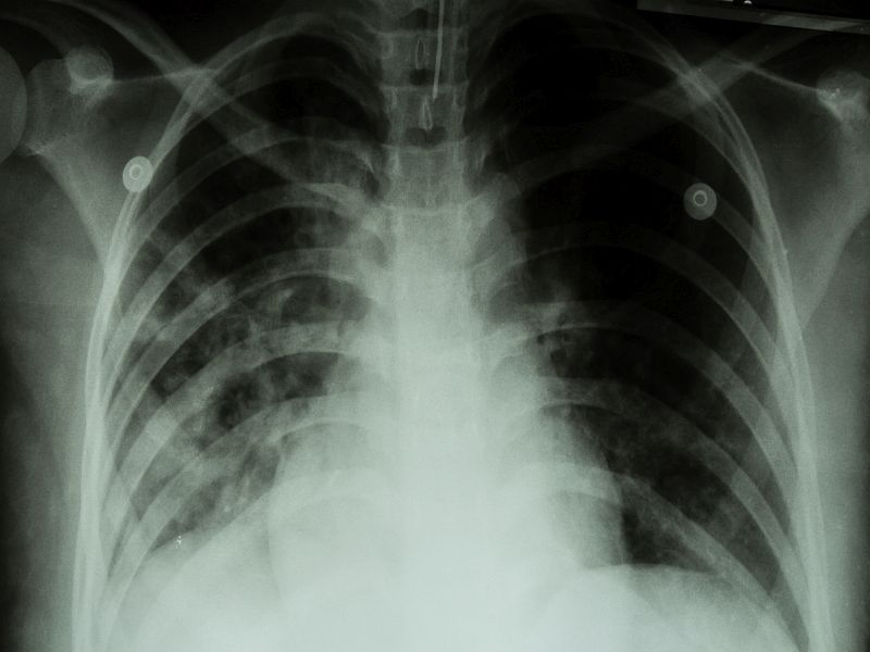 Swiss Report Highlights Danger of Drug-Resistant Tuberculosis